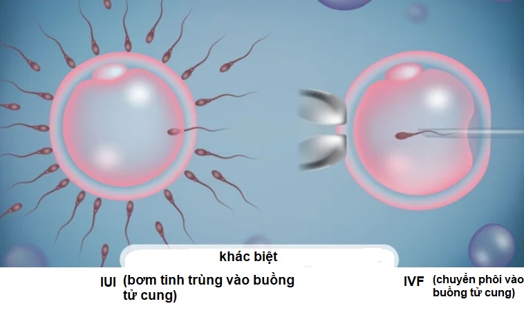 IUI khác với IVF như thế nào?