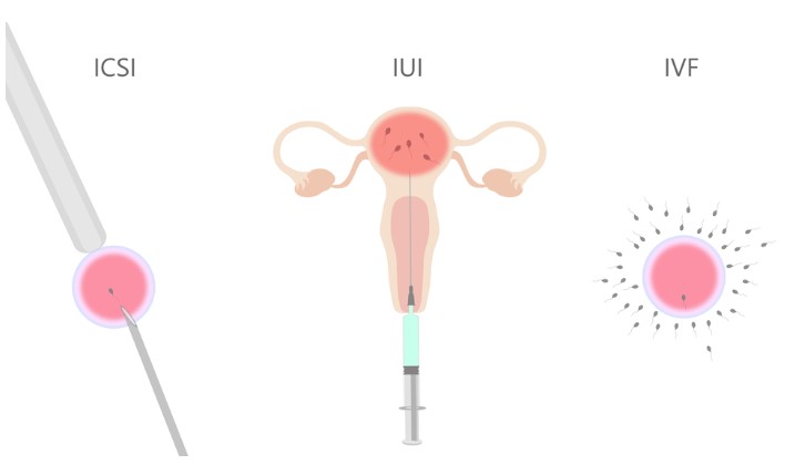 Công nghệ hỗ trợ sinh sản là gì?