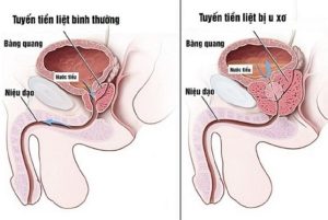 Phì đại tiền liệt tuyến là gì? Nguyên nhân, chữa trị và phòng ngừa