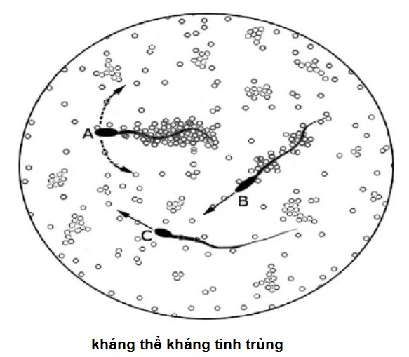 Nguyên dân vô sinh do kháng thể kháng tinh trùng