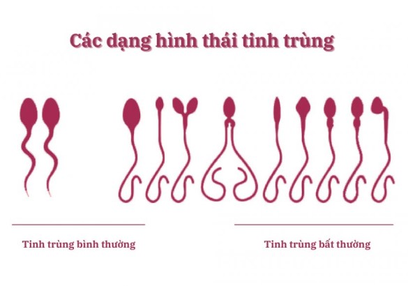 Hình ảnh tinh trùng bình thường như thế nào?