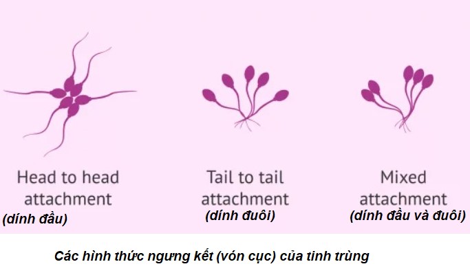 Các kiểu vón cục của tinh trùng