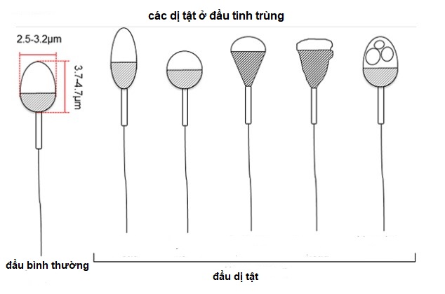 Dị dạng phần đầu, cổ của tinh trùng