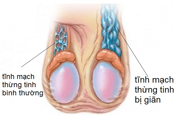 Giãn tĩnh mạch thừng tinh là gì?