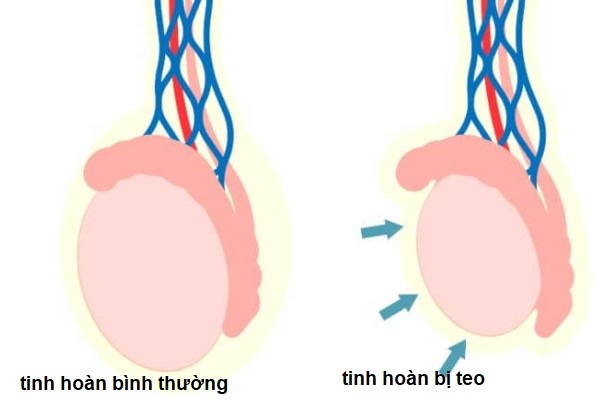 Teo tinh hoàn là gì?