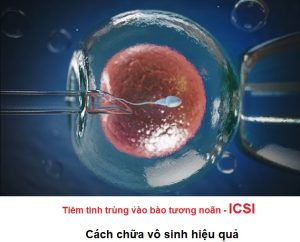 Tiêm tinh trùng vào bào tương noãn ICSI