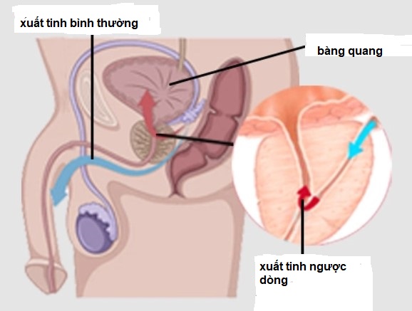 xuất tinh ngược là gì