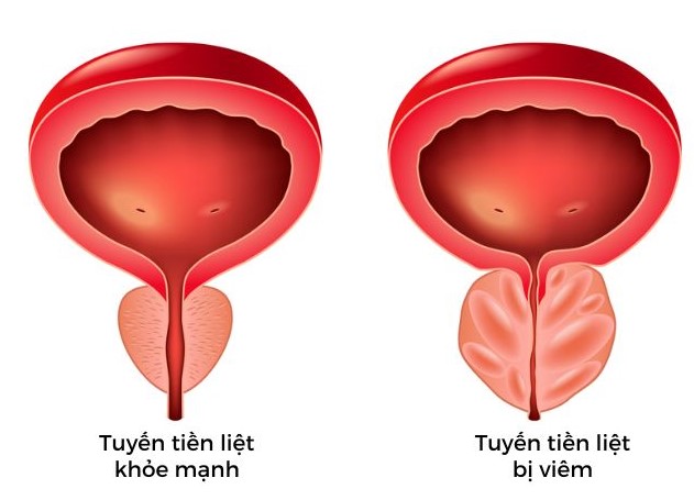 Viêm tuyến tiền liệt là gì?