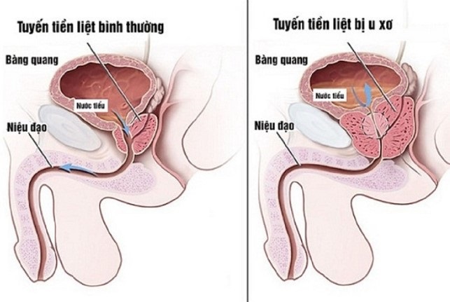 Phì đại tiền liệt tuyến