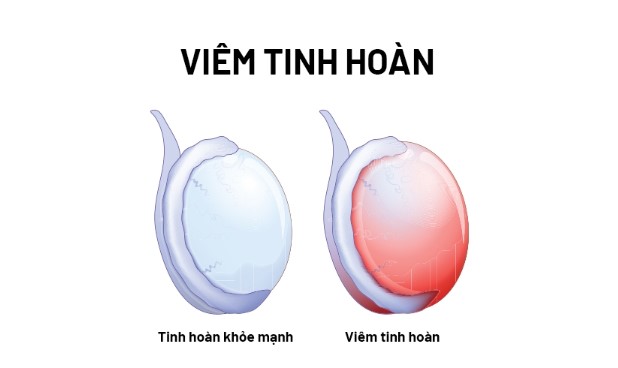 Viêm tinh hoàn là gì?